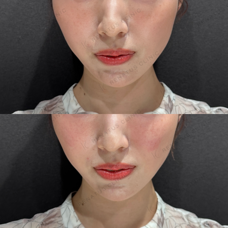 頬ヒアルロン酸ボリフト症例写真