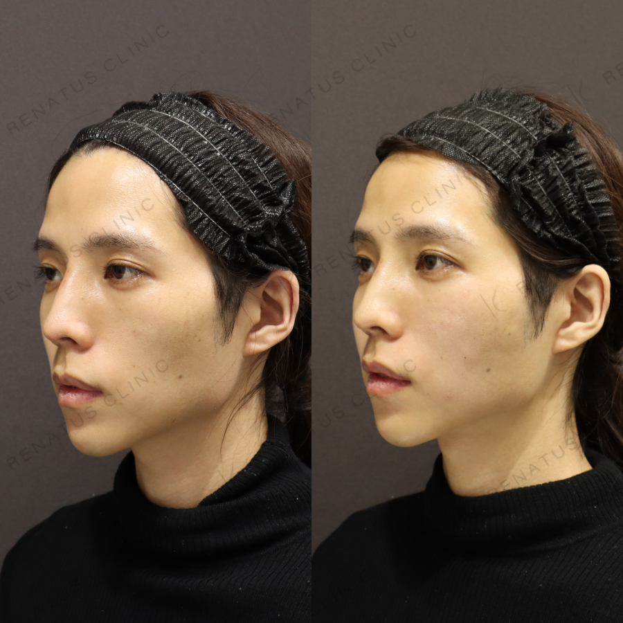 頬ヒアルロン酸症例写真