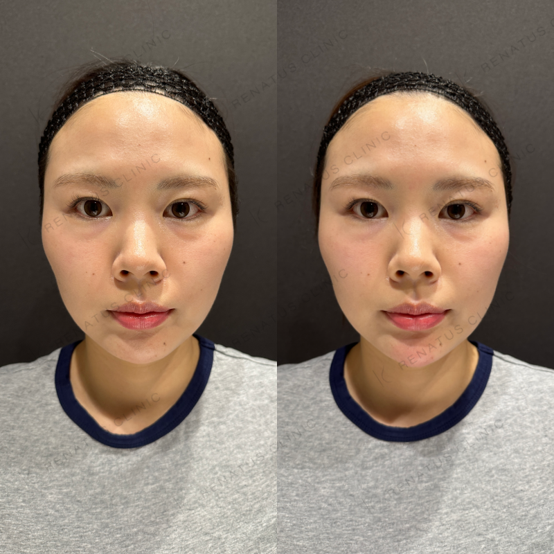顎ヒアルロン酸ボラックス症例写真