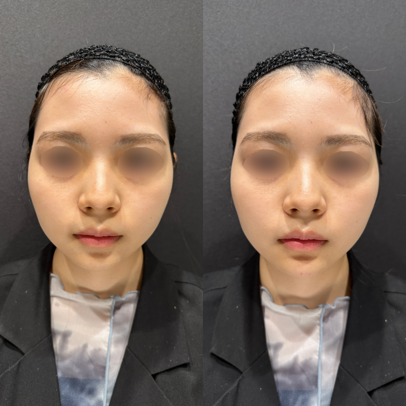 顎ヒアルロン酸ボラックス症例写真