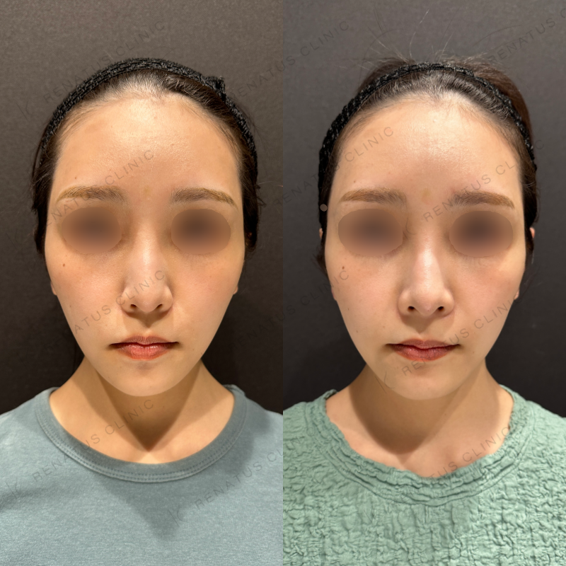 鼻中隔ヒアルロン酸ボラックス症例写真