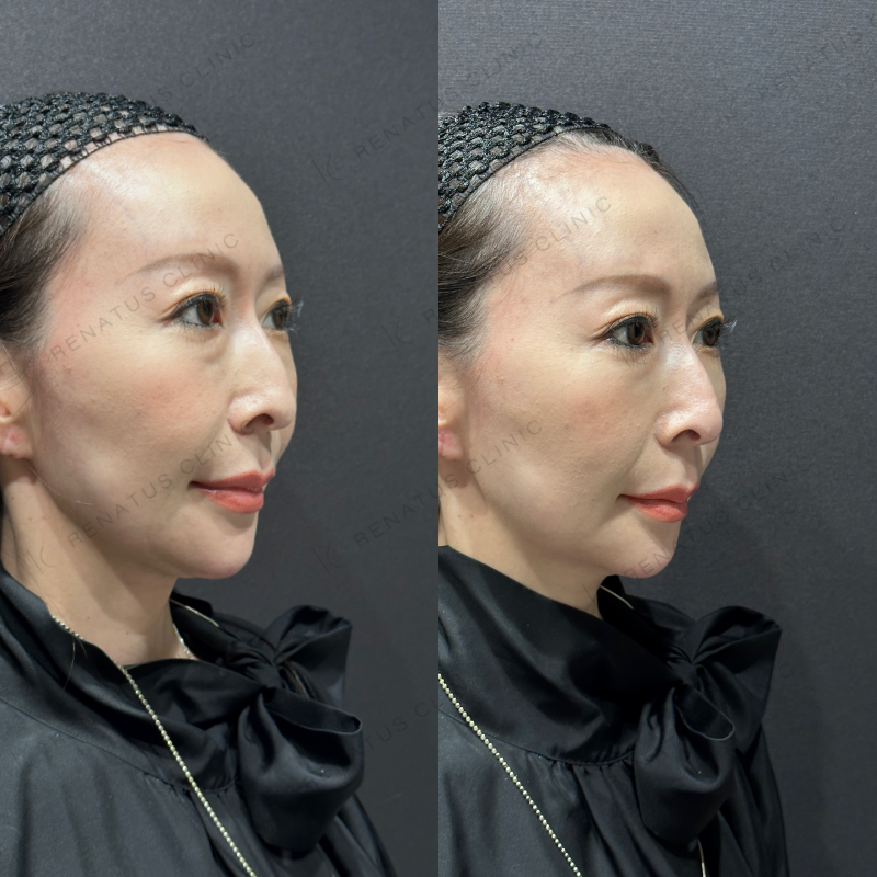 鼻ヒアルロン酸ボラックス症例写真