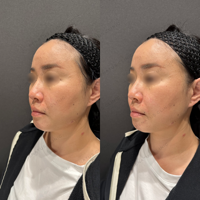 ほうれい線ヒアルロン酸ボリフト症例写真