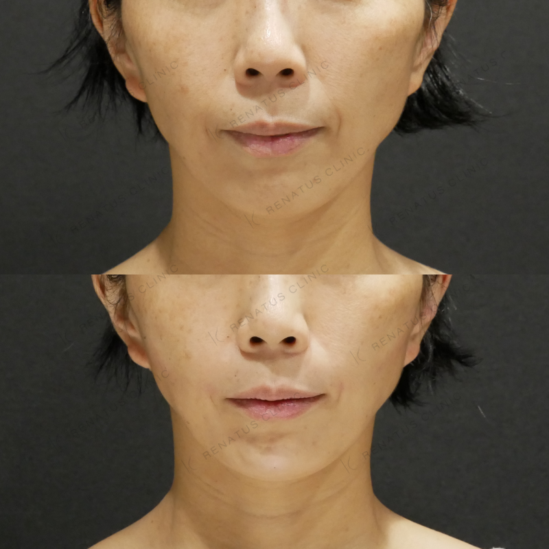 ほうれい線ヒアルロン酸ボリフト症例写真