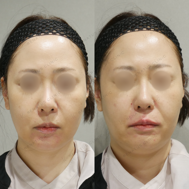 唇ヒアルロン酸ボルベラ症例写真