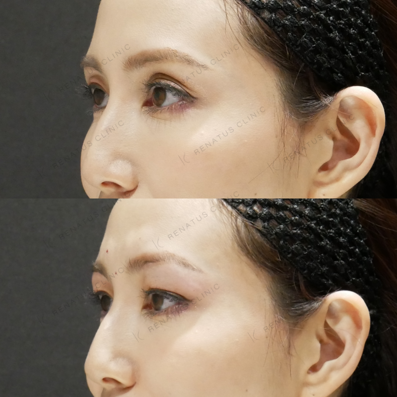 目の上ヒアルロン酸ボルベラ症例写真