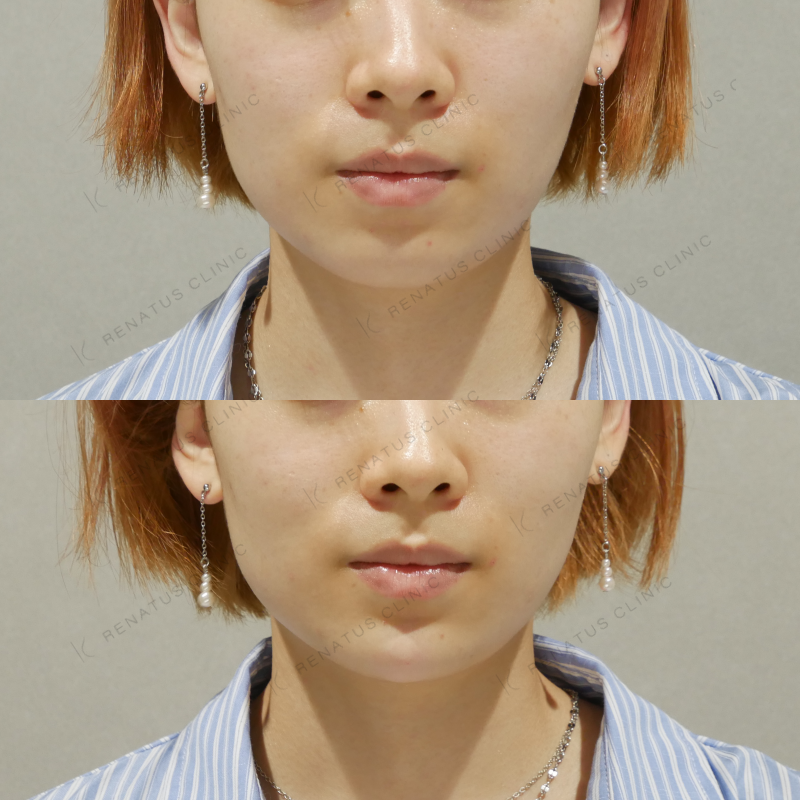 顎ヒアルロン酸ボラックス症例写真