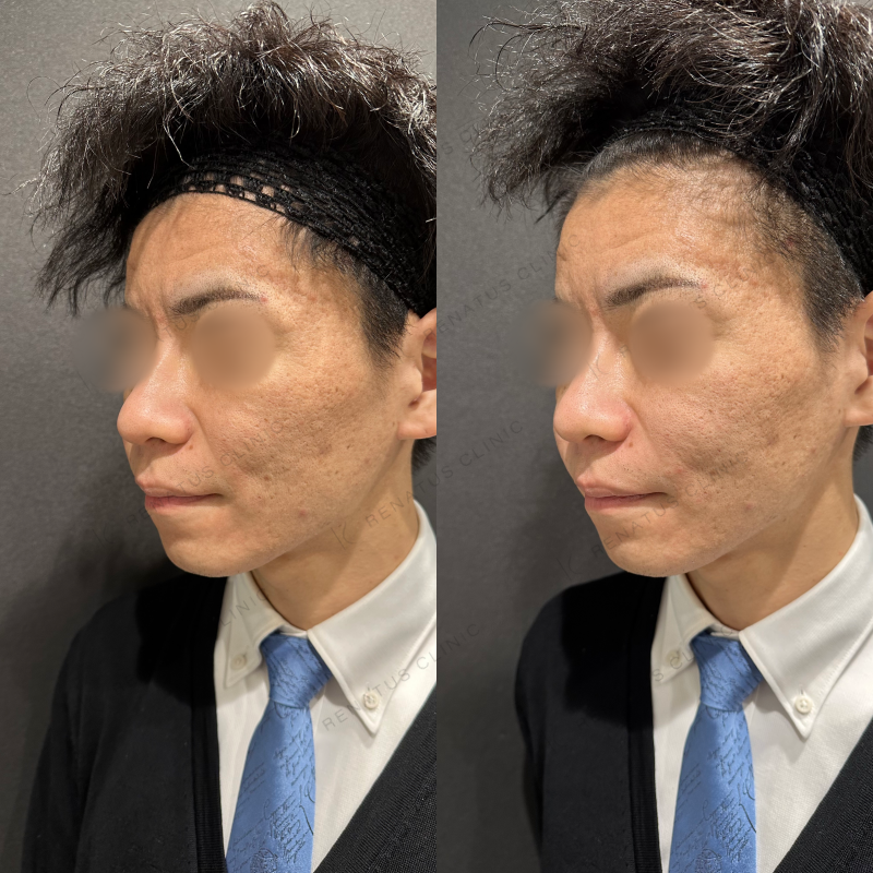 ほうれい線ヒアルロン酸ボリフト症例写真