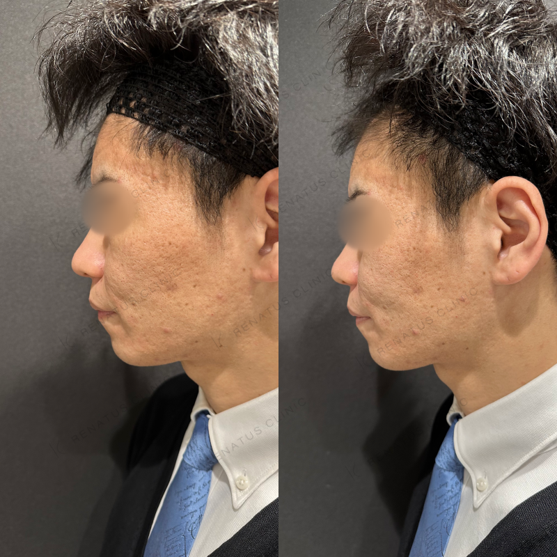ほうれい線ヒアルロン酸ボリフト症例写真