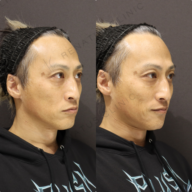 マリオネットヒアルロン酸症例写真
