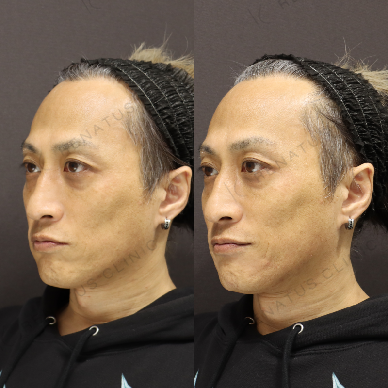 マリオネットヒアルロン酸症例写真