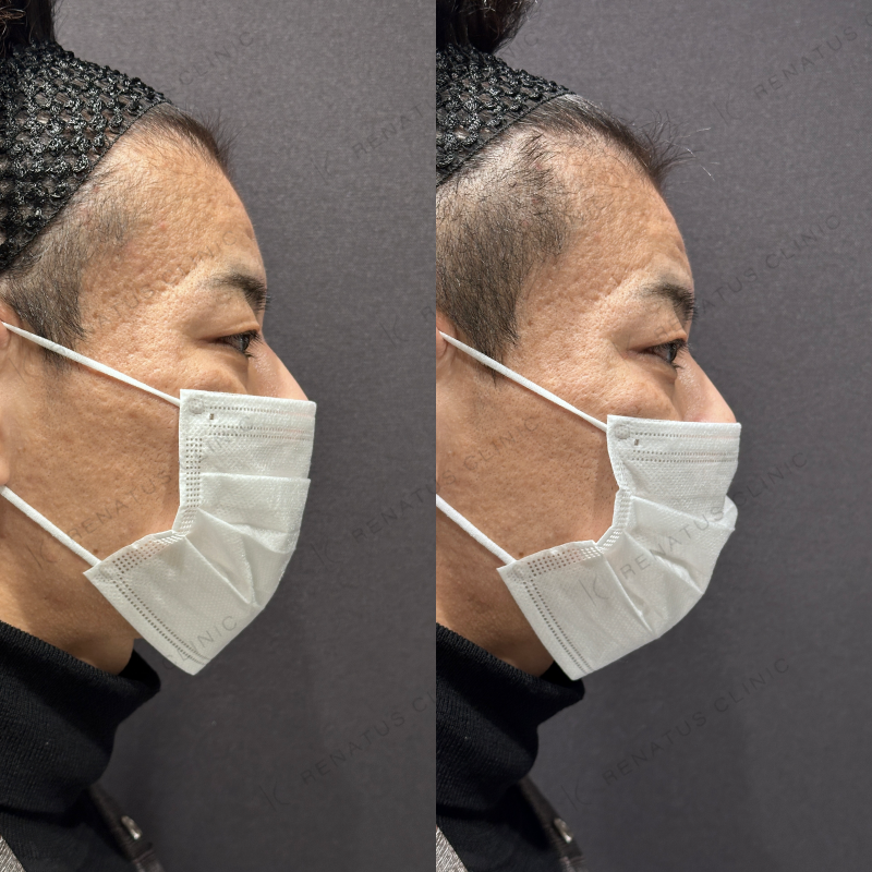 涙袋ヒアルロン酸ボルベラ症例写真
