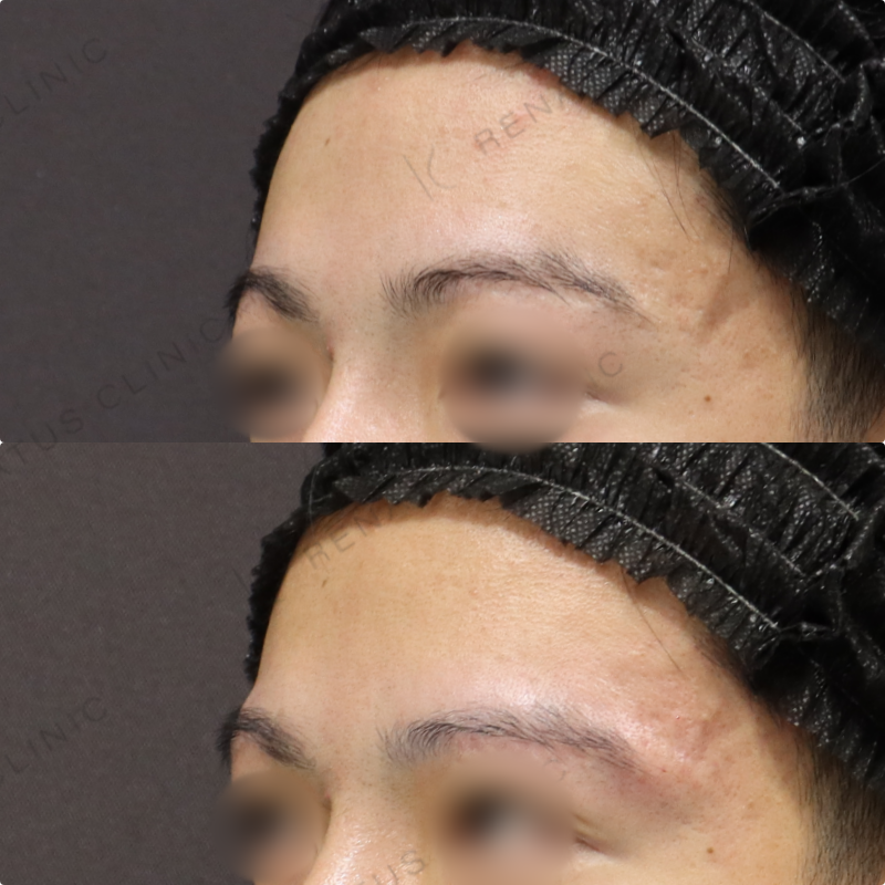眉上ヒアルロン酸症例写真
