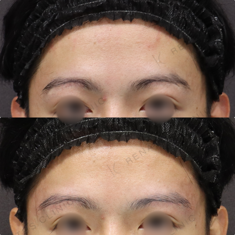 眉上ヒアルロン酸症例写真