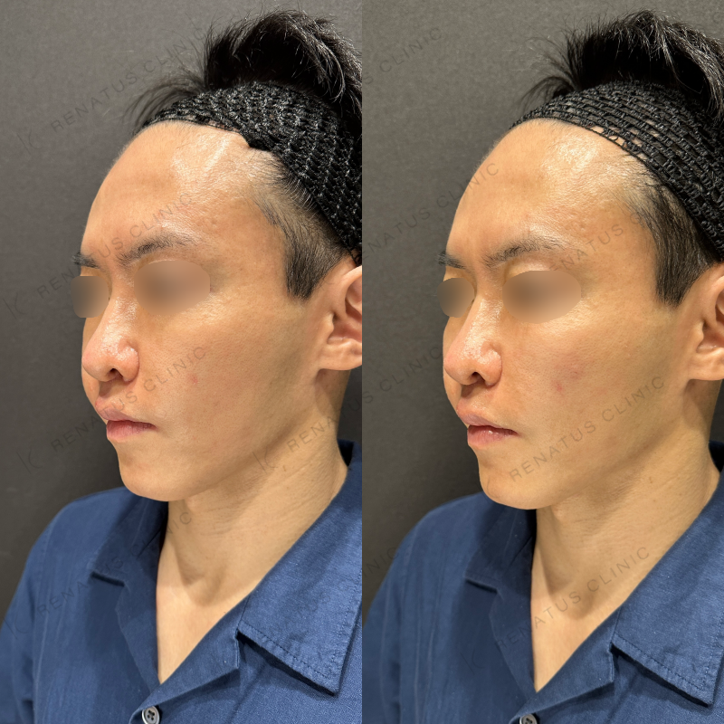 頬ヒアルロン酸ボリフト症例写真