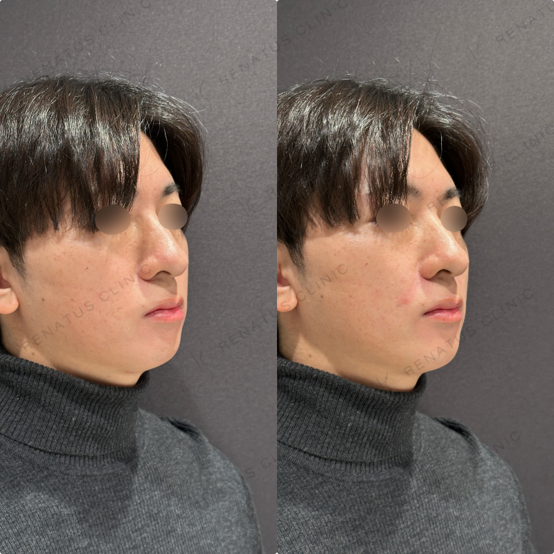 鼻翼基部・ほうれい線ヒアルロン酸ボリフト症例写真