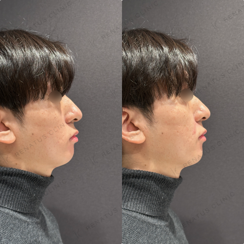 鼻翼基部・ほうれい線ヒアルロン酸ボリフト症例写真