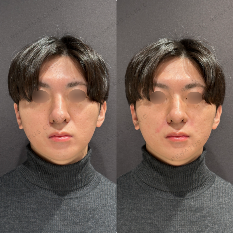 鼻翼基部・ほうれい線ヒアルロン酸ボリフト症例写真