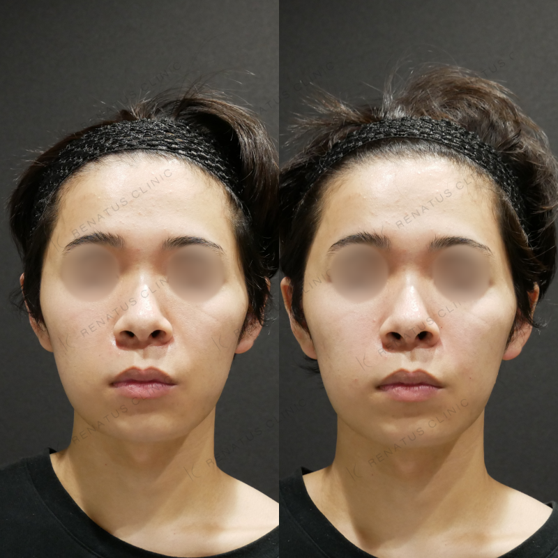 頬ヒアルロン酸ボライト症例写真