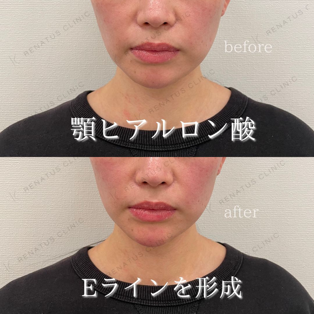 顎ボラックスヒアルロン酸