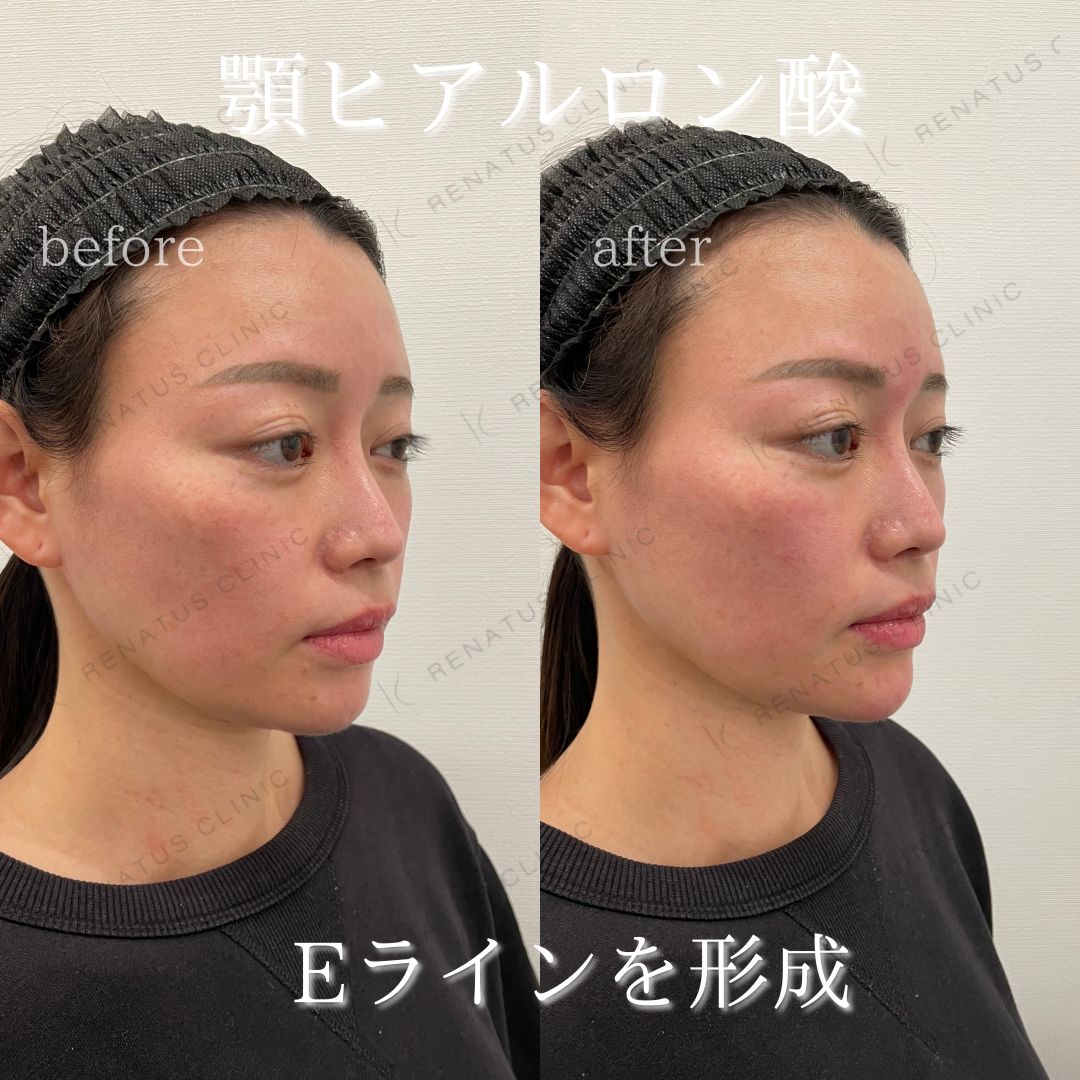 顎ボラックスヒアルロン酸