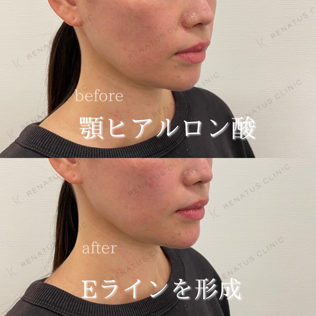 顎ボラックスヒアルロン酸