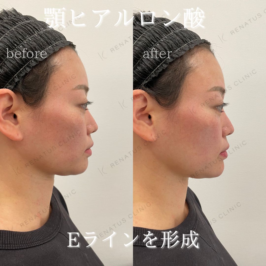 顎ボラックスヒアルロン酸