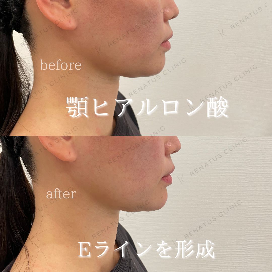 顎ボラックスヒアルロン酸