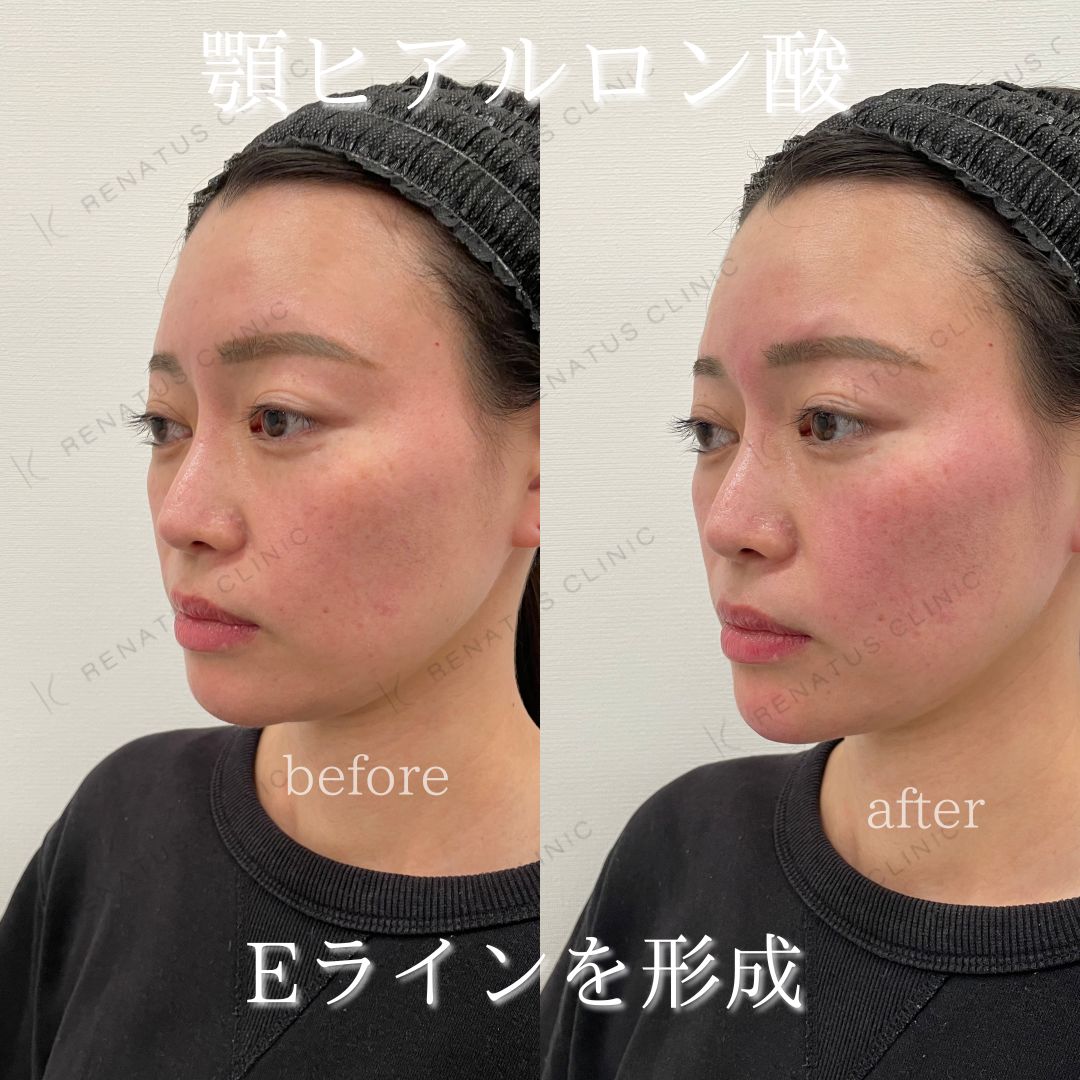 顎ボラックスヒアルロン酸