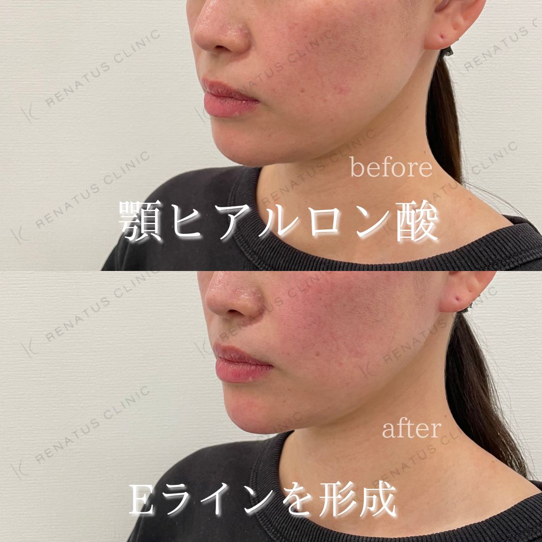 顎ボラックスヒアルロン酸