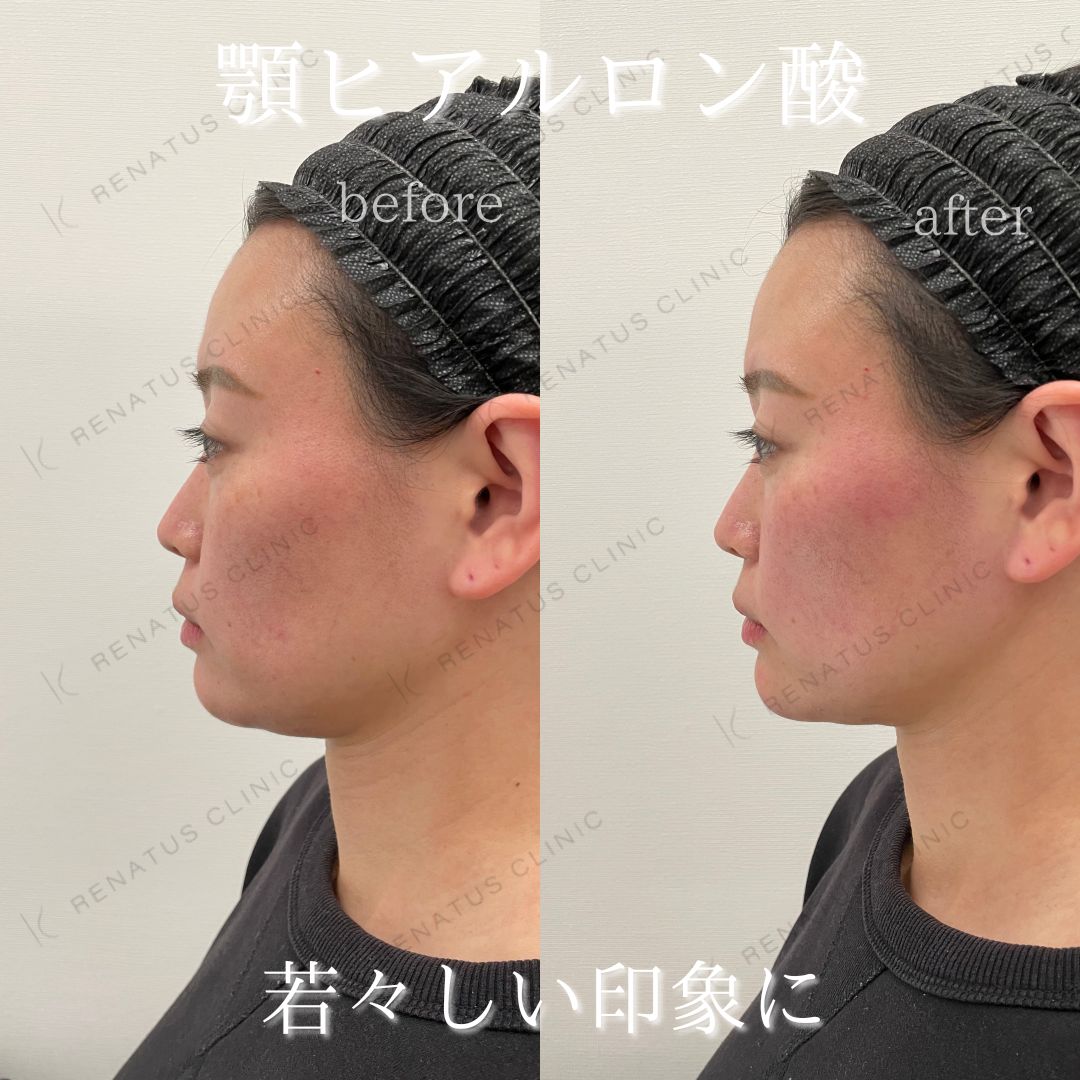 顎ボラックスヒアルロン酸