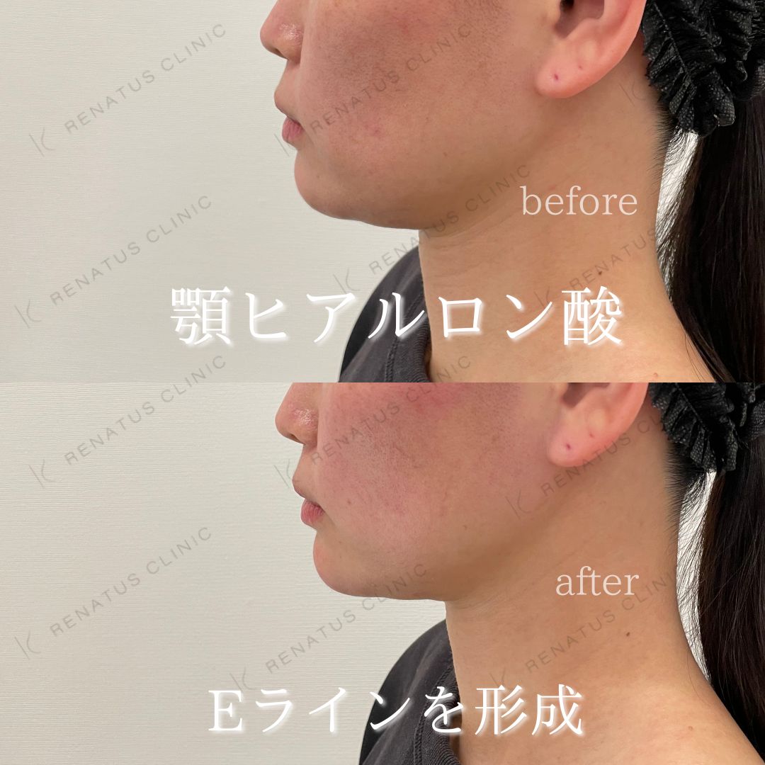 顎ボラックスヒアルロン酸