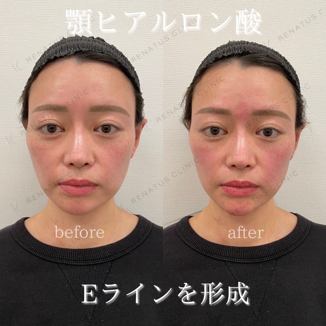 顎ボラックスヒアルロン酸