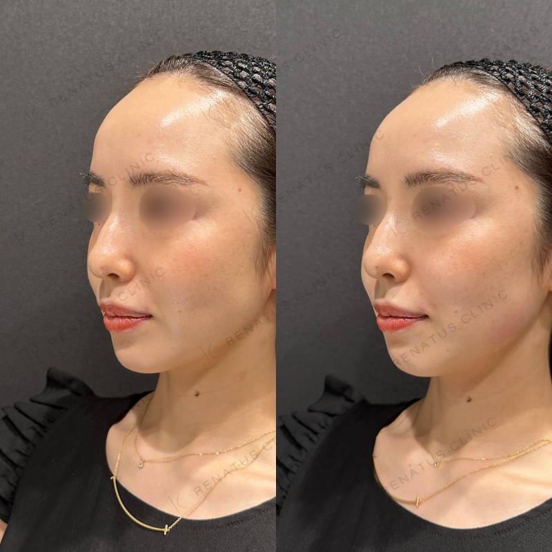 ほうれい線ヒアルロン酸ボリフト症例写真