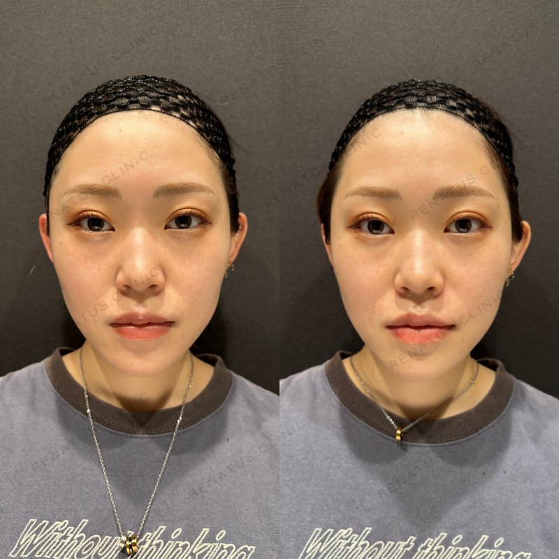 ほうれい線ヒアルロン酸ボリフト症例写真