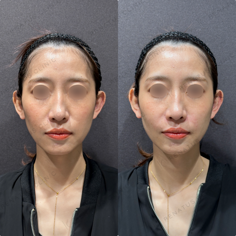 ほうれい線ヒアルロン酸ボリフト症例写真