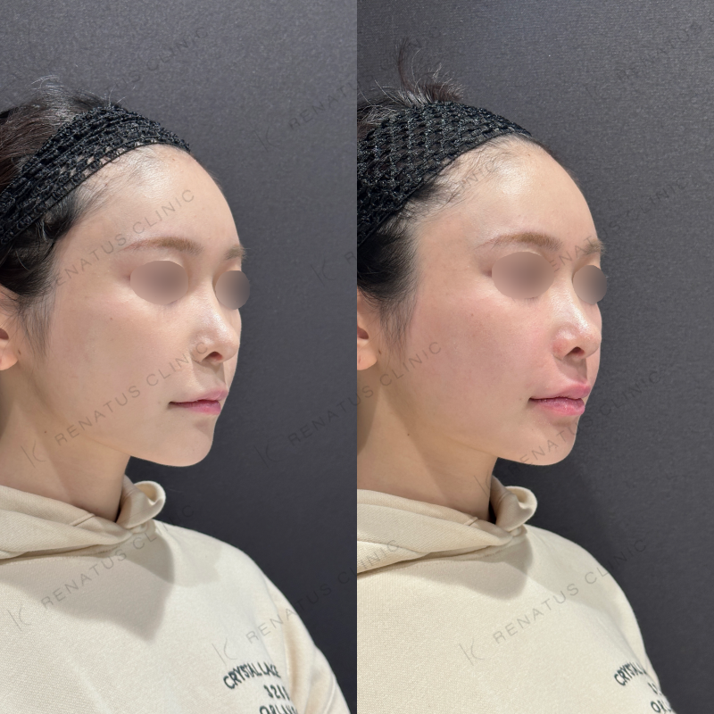 ほうれい線・唇ヒアルロン酸ボリフト・ボルベラ症例写真