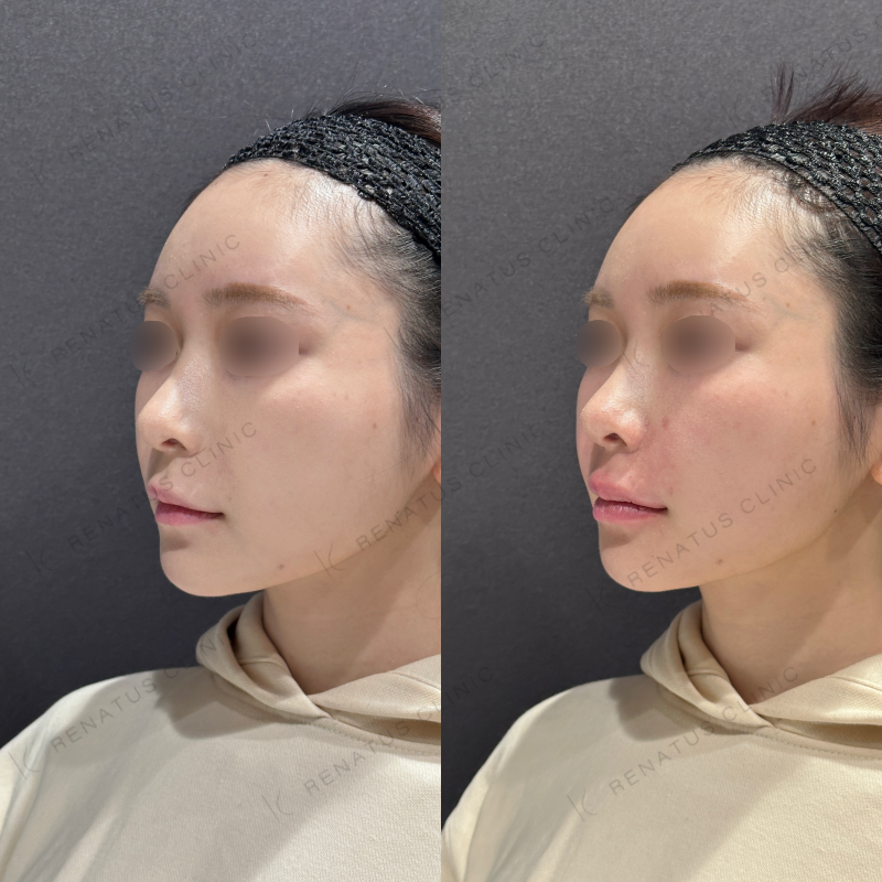 ほうれい線・唇ヒアルロン酸ボリフト・ボルベラ症例写真