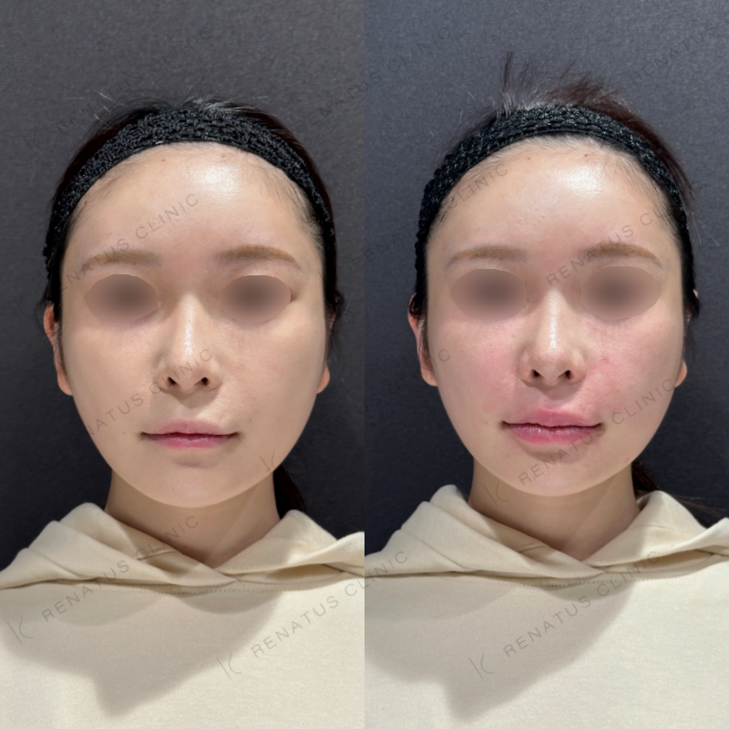 ほうれい線・唇ヒアルロン酸ボリフト・ボルベラ症例写真