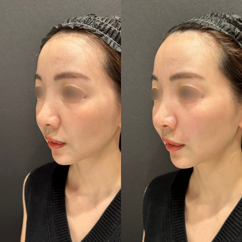ほうれい線・頬ヒアルロン酸ボリフト症例写真