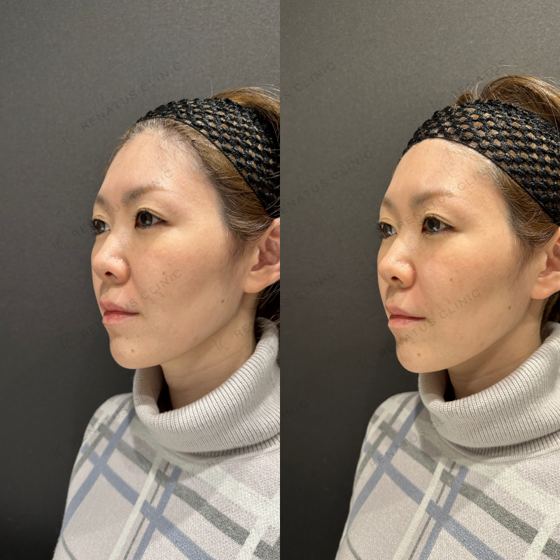 ほうれい線ヒアルロン酸ボリフト症例写真