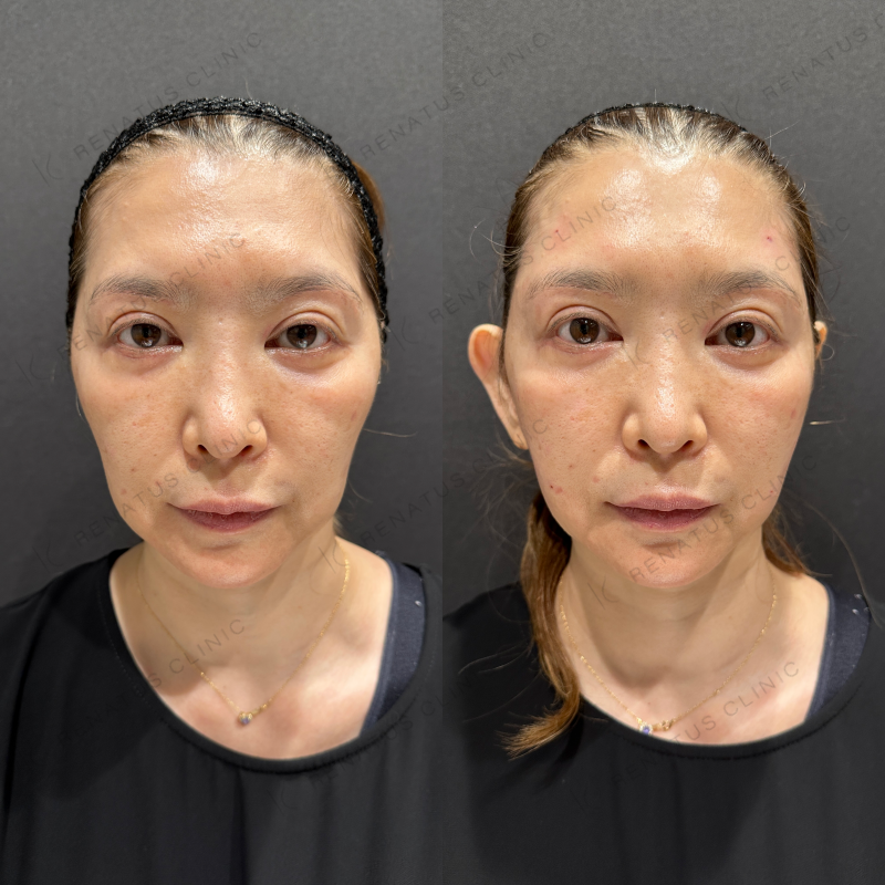 ゴルゴラインヒアルロン酸ボライト症例写真