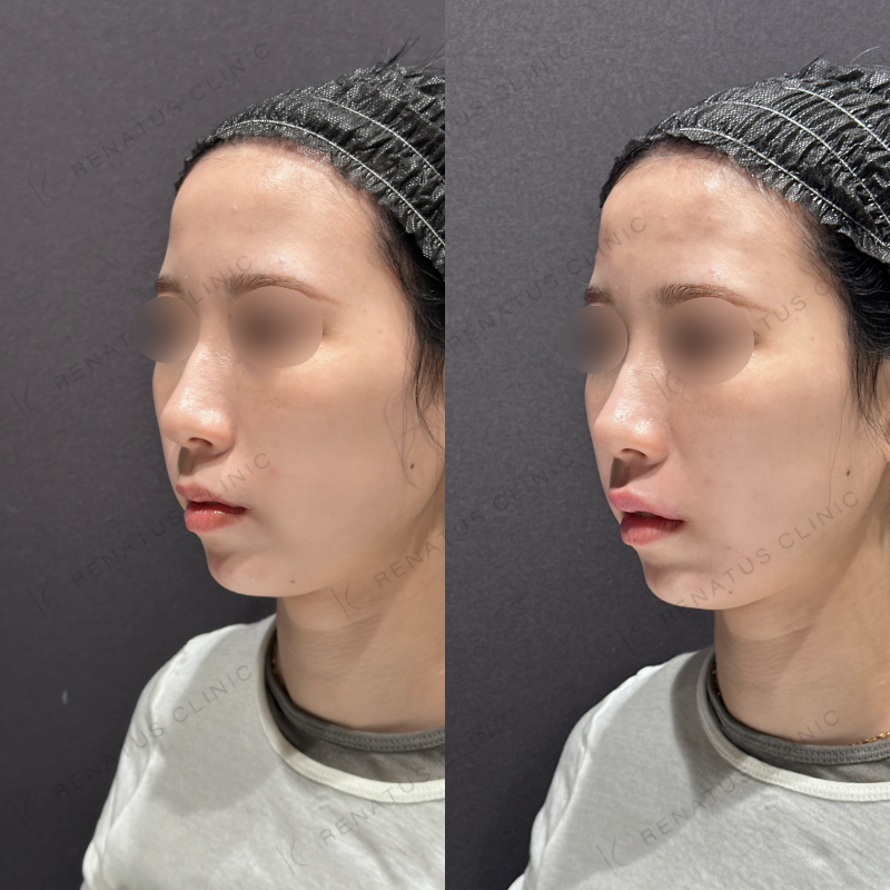 唇ヒアルロン酸ボルベラ症例写真