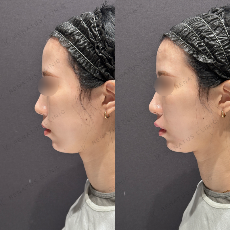 唇ヒアルロン酸ボルベラ症例写真