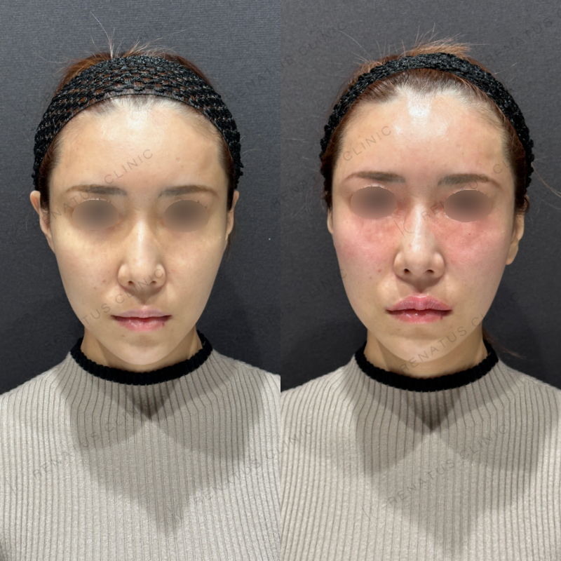 唇ヒアルロン酸ボルベラ症例写真
