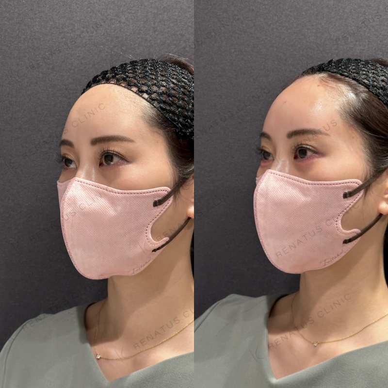 涙袋ヒアルロン酸ボルベラ症例写真