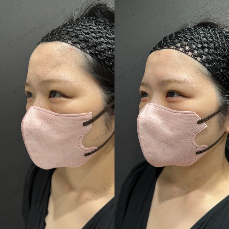 涙袋ヒアルロン酸ボルベラ症例写真