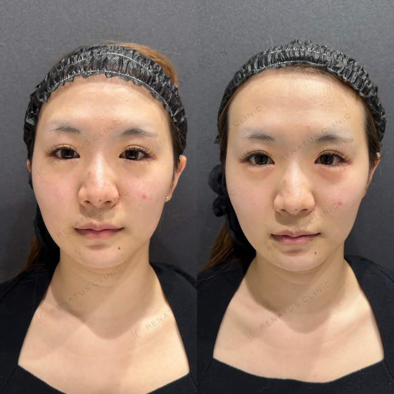 涙袋ヒアルロン酸ボルベラ症例写真