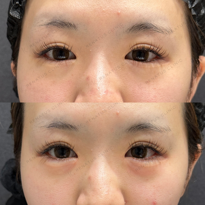 涙袋ヒアルロン酸ボルベラ症例写真