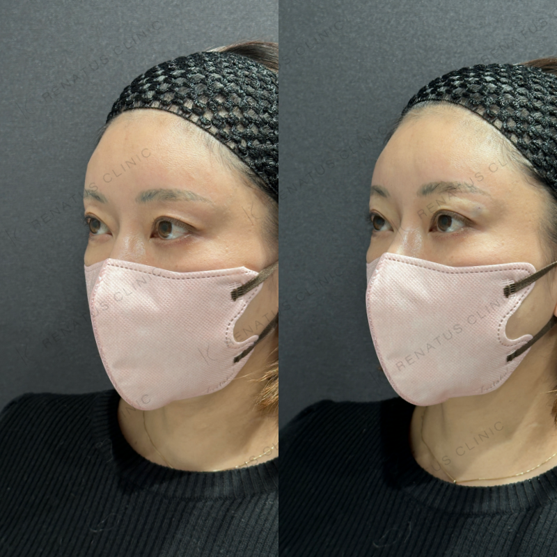 目の上ヒアルロン酸ボルベラ症例写真